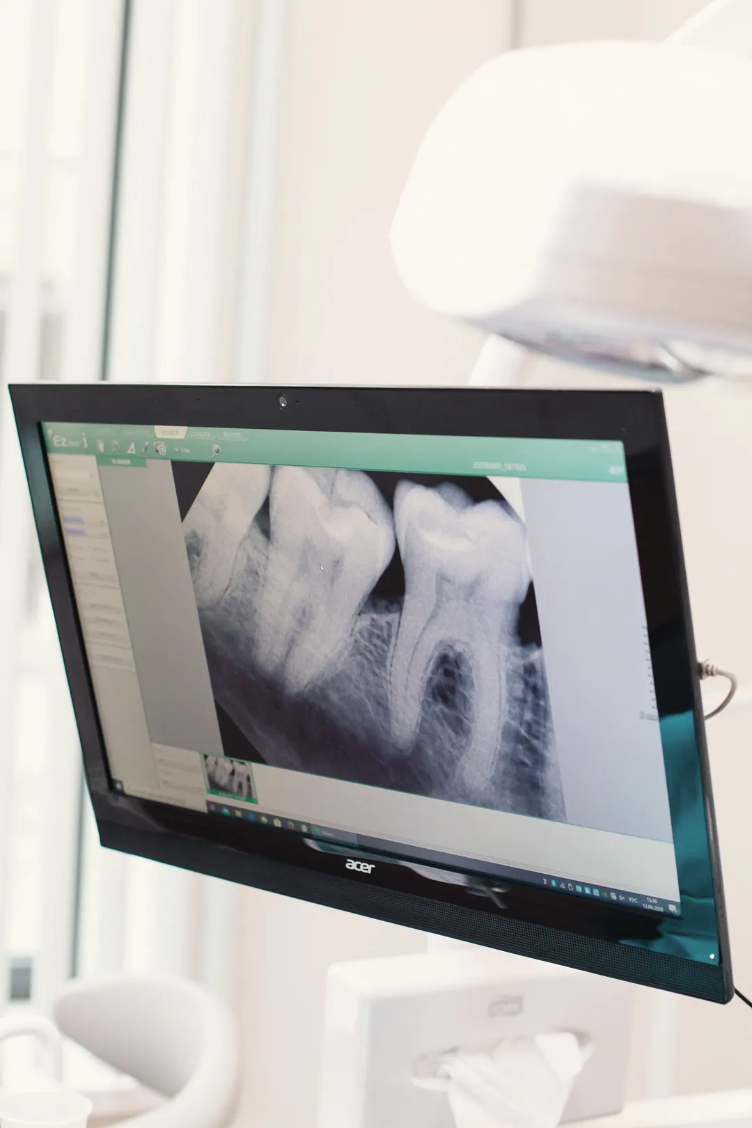 A periapical dental X-ray of molars on a monitor in the surgery