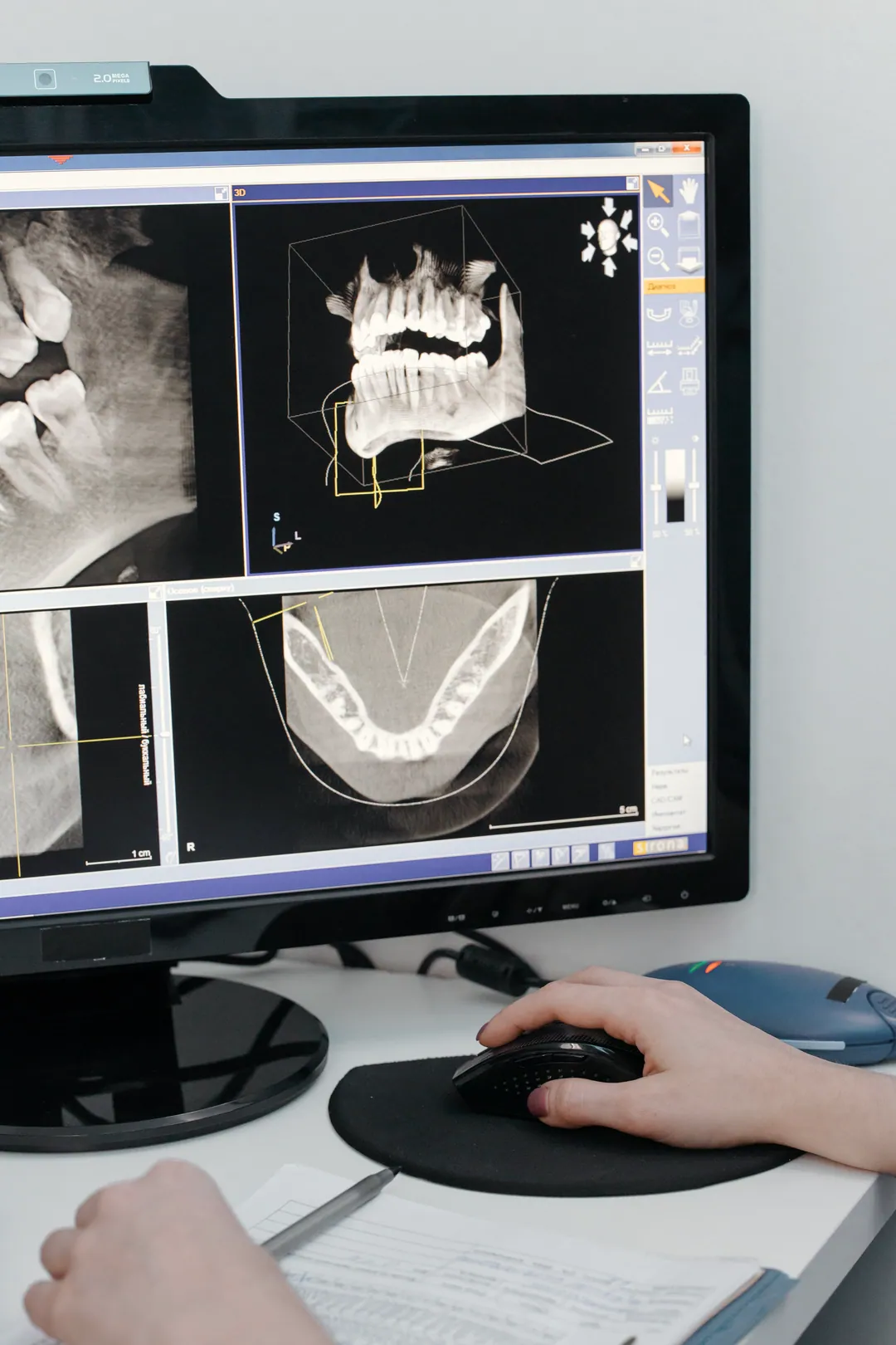 A hand on a mouse in front of a monitor showing 3D dental scan views