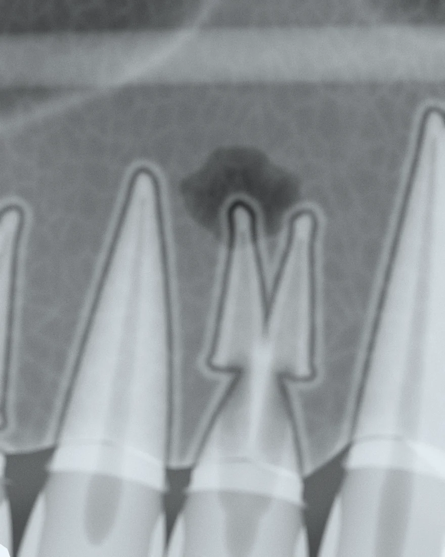 Radiografie: leziune la vârful rădăcinii dintelui 14.