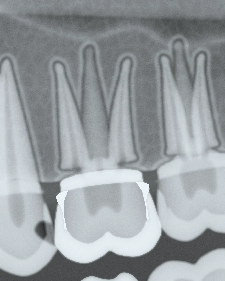 Radiografie: coroană metalo-ceramică pe dintele 26.