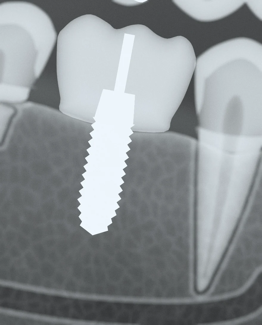 Radiografie: implant din titan cu coroană, în locul dintelui 46.