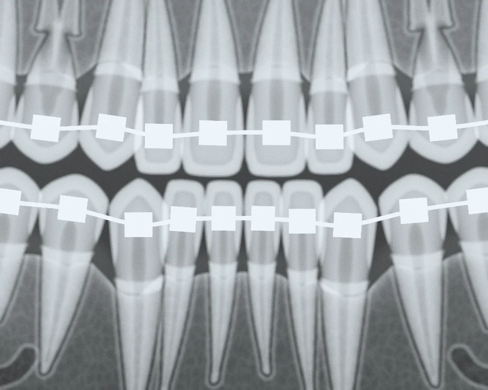 Radiografie: aparat dentar fix cu brackeți și arc.