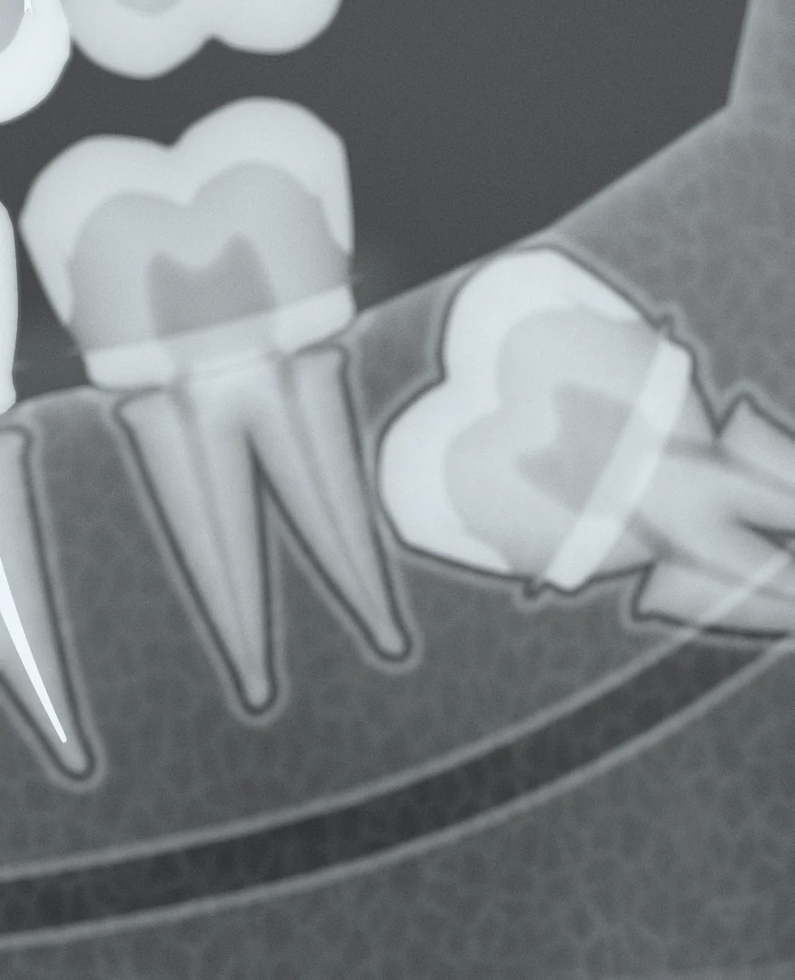 Radiografie: molar de minte 38 inclus, înclinat spre dintele vecin.