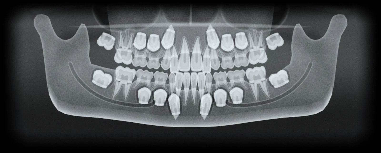 Radiografie panoramică la un copil de opt ani: dinți de lapte, dinți permanenți în formare, primii molari permanenți erupți.