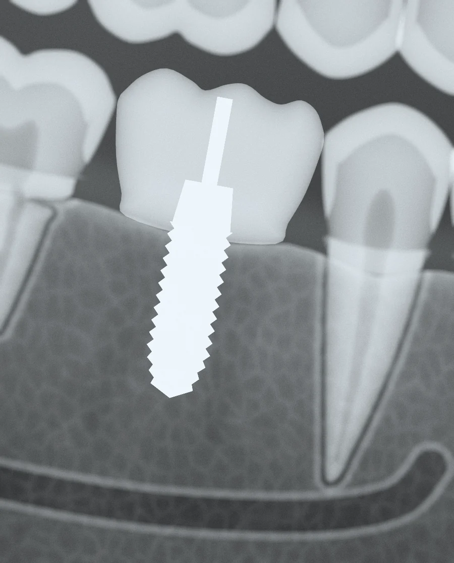 După integrare: coroana din zirconiu pe implant.
